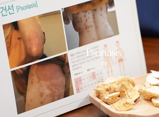 생기한의원 건선 정보에서 다루는 만성 경과 이해하기